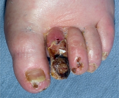 Figure 3 Infective necrosis of second toe.