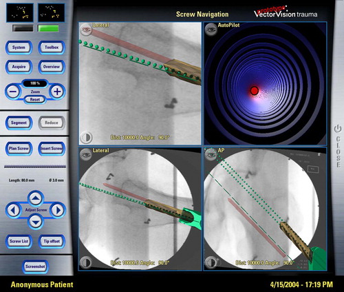 Figure 3. Navigation screen during the use of the navigated PDG on the cadaver trial. The three X-ray-based images show in axial and AP views the initially planned trajectory of the first caudal screw (red line). The two green lines visualize the potential aiming device, including the projected position of the caudal (green broken line) and cranial (green dotted line) drill canals through the PDG. The navigated drill bit positioned in the cranial screw canal is shown in brown with a larger diameter and displayed in combination with the PDG.