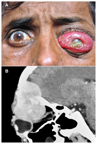Figure 3 External photograph and CT scan of the patient showing gross proptosis of the left eye with severe conjunctival chemosis, and a large mass lesion in the superior orbit. External photograph of the patient showing gross proptosis of the left eye with severe conjunctival chemosis (A). CT scan with sagittal reconstruction showing a large mass lesion in the superior orbit with extension into the frontal sinus and intracranial space (B).