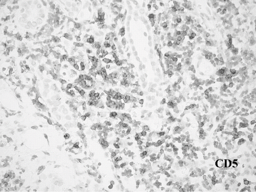 Figure 3. Renal CD5. Diffuse interstitial mononuclear cell infiltrate staining strongly positive with CD5 antibody.