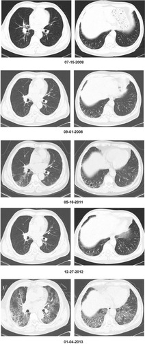 Figure 3 The patient’s chest CTs over a 4-year period. The CT scan shows a progressive pulmonary affectation during the last 2 months.
