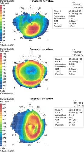 Figure 1 Representative topographies of irregular cornea patients: keratoconus, post-LASIK, and post penetrating keratoplasty.