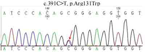 Figure 2 Sequencing peak of probands of family 1.