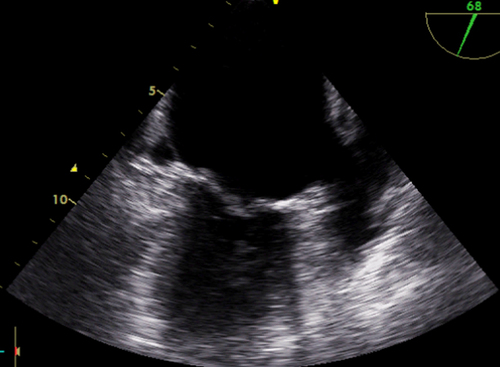 Figure 3 Pre-procedure transesophageal echocardiography.