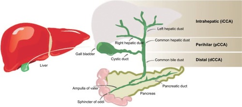 Figure 1 Locations of CCA in the biliary tree.