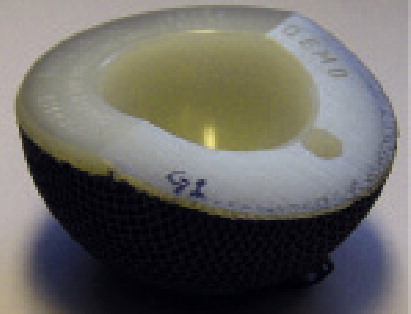 Figure 1. Polyethylene acetabular cup with titanium mesh molded on the outside.