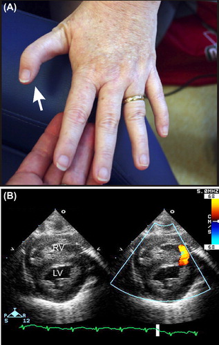 Figure 3. Phenotypic features of Diamond–Blackfan anemia (DBA). (A) Abnormal thumb in an adult with an RPL11 mutation. (B) Muscular ventricular septal defect. Note the blood flow across the defect. LV = left ventricle; RV = right ventricle. Echocardiogram courtesy of Patrick Jay, MD, PhD.