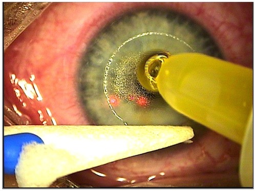 Figure 1 Riboflavin solution applied over the bare stroma without contact with the LASIK flap for 60 seconds.