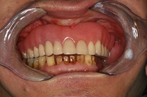 Figure 16 Maxillary immediate denture in situ.