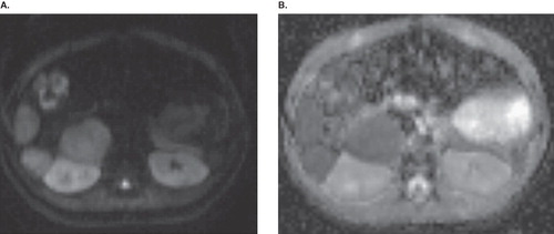 Figure 2.  On b = 800 s/mm2 (A) diffusion trace image the lesions have high signal intensities. Corresponding apparent diffusion coefficient (ADC) map (B) demonstrates low signal intensities suggesting restricted diffusion.
