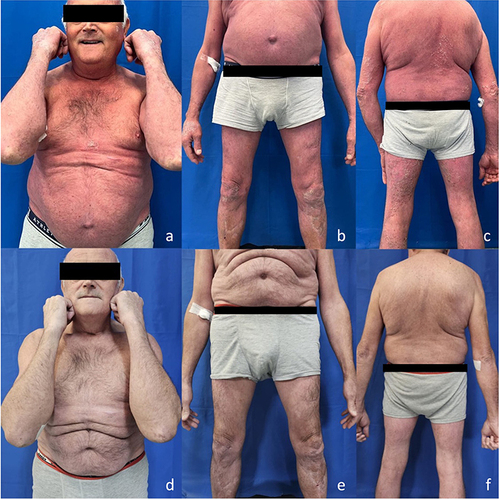Figure 1 Patient at baseline (a–c) and after 16 weeks (d–f) of treatment with risankizumab.