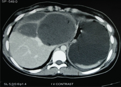 Figure 1 CT abdomen: 11 × 10 × 6 cm cystic lesion with areas of rim calcification and few small cysts within it noted in the left lobe of liver extending into lesser sac. Mild ascites. Suggestive of hydatid disease of liver.