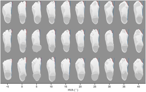 Figure 4. Randomly sampled left foot scans with hallux valgus angles growing in 5° steps. The red and blue lines are the hallux medial line and the baseline used to calculate the HVA.