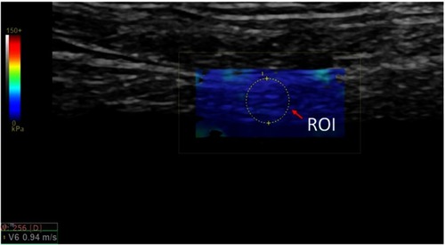 Figure 2 Bladder wall 2D Shear Wave Elastography image. SWV measurement of the bladder wall: Blue square – SWE map. Yellow circle – ROI (region of interest) – represents the bladder wall with SWV measurement within the SWE map.