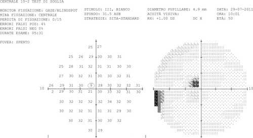 Figure 2 Central 10 degree perimetry from July 2011 revealing a small perifoveal scotoma with a sensitivity of 9 dB (indicated by the gray circle in the left numerical pattern).