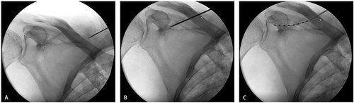 Figure 3 Accessing the suprascapular nerve using fluoroscopy. (A) needle entry site; (B) final needle placement; and (C) final lead placement. Figures courtesy of Nalu Medical. ©2024.