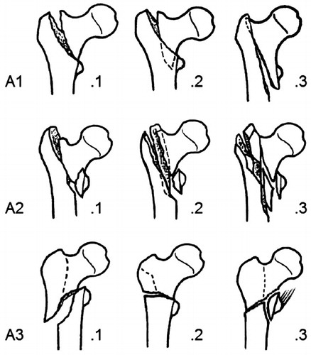Figure 1. AO/OTA type-31-A pertrochanteric fractures. 31-A1 fractures are simple, whereas 31-A2 fractures are multifragmentary. Subgroups of 31-A2 pertrochanteric fractures are A2.1 (detachment of the lesser trochanter), A2.2 (several intermediate fragments including detachment of the lesser trochanter), and A2.3 (several intermediate fragments extending more than 1 cm distal to the lesser trochanter). 31-A3 intertrochanteric fractures all have a fracture line through the lateral femoral wall, anatomically defined as the lateral femoral cortex distal to the greater trochanter. (Reprinted, with permission from: Orthopaedic Trauma Association Classification, Database and Outcomes Committee. Fracture and dislocation classification compendium - 2007. J Orthop Trauma 2007; 10 Suppl.)
