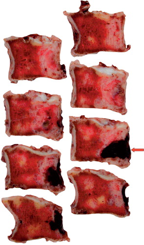 Figure 6. Multiple macroscopic sections of the L5 VB. The pedicles were removed during the first stage of the operation. The arrow indicates the epicentre of the chordoma in the posterior part of the VB where it crossed the posterior wall.