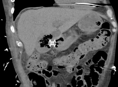 Figure 6 Computed tomography (CT) scan after 2 months of follow-up showing a cholecystoduodenostomy using electrocautery lumen-apposing metal stent (EC-LAMS).