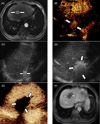 Figure 1. MWA in a 56-year-old man with intrahepatic recurrence of HCC adjacent to the diaphragm. (A) CE-MRI imaging obtained before ablation showed a hyper-enhanced area in segment II (long arrow). (B) The CEUS revealed a hyper-enhanced nodule in the left lobe. (C) Adjuvant 2.5 mL of ethanol was injected into the tumour edge adjacent to the diaphragm. (D) In the process of MWA, the hyper-echo completely covered the tumour. (E) CEUS obtained 3 days after ablation showed no enhancement (long arrow). (F) CE-MRI imaging obtained 4 months after ablation displayed no enhancement in the ablation zone (long arrow).