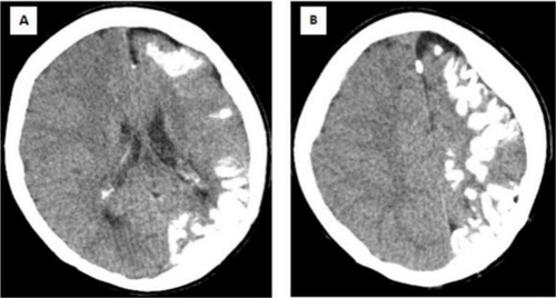 Figure 2 A computed tomography of the brain reveals unilateral left-sided moderate atrophy of the cerebral hemisphere (A) with extensive gyriform cortical-subcortical (tram-track) calcifications (B).