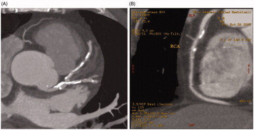 Figure 2. CT for coronary artery calcification. (A) Calcium Score for LAD (left anterior descending) – 508; (B) Calcium Score for RCA (right coronary artery) – 154.