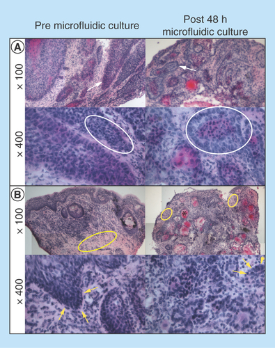 Figure 3.  Hematoxylin and Eosin-stained 8-µm tissue sections, shown at 100× and 400× magnification.Two representative tumors are shown (n = 15). (A) Laryngeal squamous cell carcinoma, staging T4aN0M0. (B) Transglottic laryngeal squamous cell carcinoma, staging T4N0M0. Each tumor is shown pre- and post-48-h microfluidic culture. The bright pink-stained areas on some of the images depict extracellular keratin (keratin pearls*), arising from the squamous cells. White arrows show infiltrating islands and cords of tumor cells. Tumor area showing orientation of cell maturation is circled in white. Pale stromal areas with inflammatory cells are circled in yellow. Intact basement membrane is shown by yellow arrows.