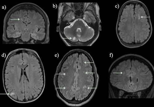 Figure 7. Silent infarcts in a group of asymptomatic children with sickle cell disease. (a) Coronal flair shows a watershed infarct in the right anterior cerebral artery/middle cerebral artery (ACA/MCA) territory (b) Axial T2-weighted image shows a mature cerebellar hemispheric infarct which could date back to birth (c) Axial FLAIR reveals a mature watershed infarct in the left ACA/MCA territory (d) A right parietal subcortical infarct on an axial FLAIR image. (e) Multiple scattered deep and subcortical white matter silent infarcts on axial FLAIR image. (f) Larger frontal deep white matter infarct of the right frontal lobe on coronal FLAIR image. The magnetic resonance angiograms were normal in all patients. FLAIR = fluid attenuated inversion recovery