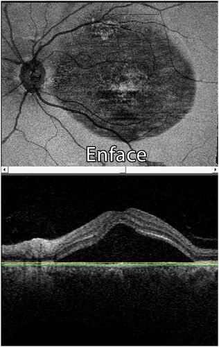 Figure 6 A case of CSCR (OCT shows sub-retinal fluid collection).
