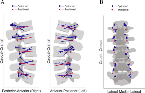 Figure 6. (A) Visualization of all the optimized screw trajectories (blue) in a reference lumbar spine projected on the sagittal plane compared with the standard plan (red). (B) Insertion points resulting from the GA method visualized on a reference lumbar spine with the standard insertion.