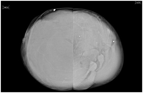 Figure 2. Mammography of the patient, showing diffuse free substance, obscuring the breast parenchyma.