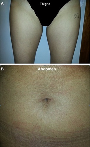 Figure 4 Clinical photographs of the treatment area before and 5 weeks after treatment for (A) thighs and (B) abdomen (right side, treated; left side, untreated).