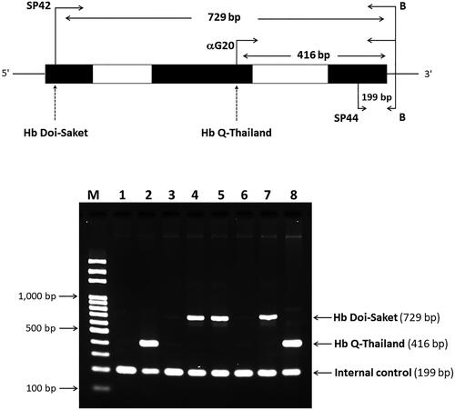 Figure 7. A multiplex ASPCR Assay for simultaneous identification of Hb Doi-Saket and Hb Q-Thailand. The locations and orientations of primers are indicated. The 729-bp fragment generated using SP42 and B is specific for αDoi-Saket, whereas the 416-bp fragment generated using αG20 and B is specific for αQ-Thailand. The 199-bp fragment is an internal control generated using SP44 and B. M, 100-bp ladder; lane 1, normal DNA; lane 2, DNA control of Hb Q-Thailand; lane 3, mother; lane 4, father; lane 5, proband; lane 6, wife of proband; lane 7, son of proband; and lane 8, Hb Q-Thailand carrier.
