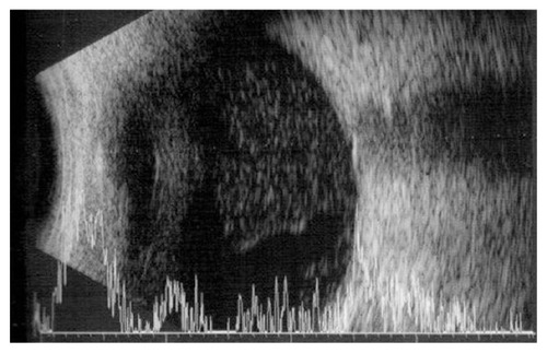 Figure 1 B-scan ultrasonography demonstrated vitreous opacities but no retinal detachment.