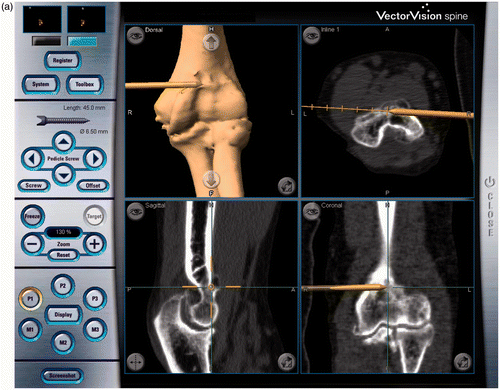 Figure 2. Navigation-assisted surgery. A drill burr with a mounted reference array is used for bone resection of the distal humerus. (a) Anterior side of the joint. The drill burr is shown as a gold rod that is drilling out the osteophyte on the coronoid fossa. (b) Posterior side of the joint. The drill is burring out the olecranon fossa.