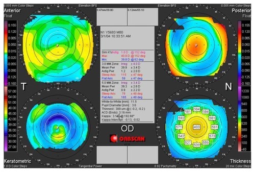 Figure 6 Two-year postoperative tomographic corneal map of a patient (DEE) from group 2.