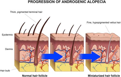 Figure 1 Progression of androgenic alopecia. The hair follicles are miniaturized due the increased concentration of dihydrotestosterone (DHT) in dermal papillae.