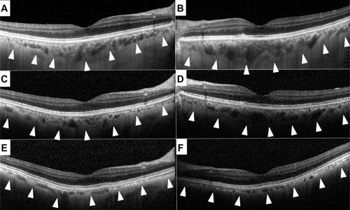 Figure 3 Spectral domain optical coherence tomographic images showing progressive choroidal thinning. These images were recorded in June 2010 (A, right; B, left), July 2011 (C, right; D, left), and October 2012 (E, right; F, left). Arrowhead shows the lower border of the choroid.
