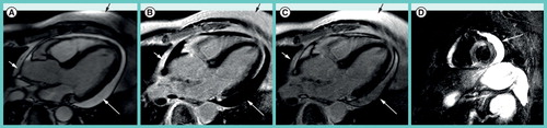 Figure 4. Images in three-chamber-view orientation obtained in a 59-year-old male with serous pericardial effusion.(A) On steady state free precession cine images, pericardial fluid (white arrows) appears slightly brighter than fat (black arrow). (B) On the late gadolinium enhancement (LGE) phase-sensitive inversion-recovery image the effusion (white arrow) appears hypointense, while pericardial and subcutaneous fat (black arrow) appear bright. (C) On magnitude LGE images the effusion (white arrow) has intermediate signal intensity less bright than fat (black arrow). (D) The triple-inverted fast spin echo (short tau inversion recovery) image highlights bright pericardial fluid (white arrow), but also the fluid-filled stomach, the spleen and the kidney.