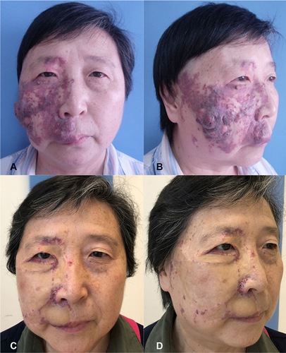Figure 1 Case 1. A 58-year-old female had large area of hypertrophic and nodular PWS in the right face which was resistant to PDL therapy. The majority of the lesions was removed, and medium-thickness skin grafting was used to repair the wound in the first-stage operation. The skin grafts survived well. Eight months later, secondary procedure was performed to relieve lower eyelid ectropion caused by scar contracture. (A and B) Preoperative views. (C and D) Postoperative views three years later. Evaluation result was “very satisfied (score of 5)”.