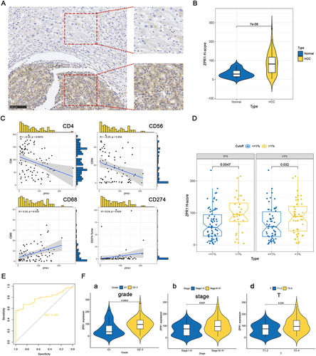 Figure 8 ZPR1 immunostaining in HCC tissue samples. ZPR1 immunostaining showing low expression in the cytoplasm of normal hepatocytes, and prominent positive expression in the cytoplasm of HCC cells. (A) The ZPR1 expression between HCC cells and adjacent normal hepatocytes in the same visual field (200 ×). (B) The H-score difference of ZPR1 expression in HCC tissues. (C and D) Correlation between ZPR1 expression and common immune cell markers, as well as PD-L1. (E) The AUC value for tumor diagnosis of ZPR1. (F) Correlation analysis of ZPR1 expression with clinicopathological characteristics.