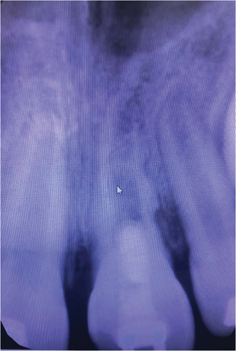Figure 11. Appointment 5 postoperative PA with MTA cap and composite seal.