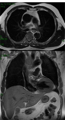 Figure 3 T1-weighted images showing residual malignant thrombosis of the superior vena cava at 40 Gy.