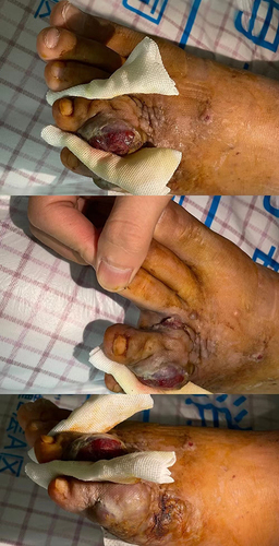 Figure 4 A new growing neoplasm was seen in the little toe of the left foot.