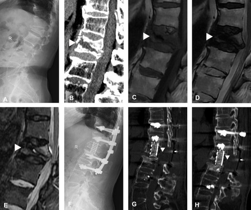 Figure 6 A titanium mesh cage (TMC) for stage III Kümmell’s disease. (A and B) Preoperative radiographs and CT scans revealed collapsed fracture and kyphosis at L1 with an intravertebral cleft (IVC) sign (white triangle). (C–E) Preoperative MRI showed a decreased signal of IVC (white triangle). (F) No subsidence in immediate postoperative plain radiographs. (G and H) Final follow-up CT scans showed kyphosis recurrence with TMC subsidence (white triangle).