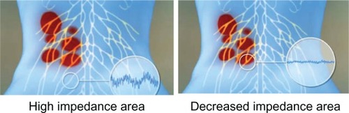 Figure 3 Computer imaging is used to analyze the data, to identify the lowest points of electrical resistance and to select the areas for therapeutic stimulation.Courtesy, Ori Kanner, Nervomatrix Ltd.