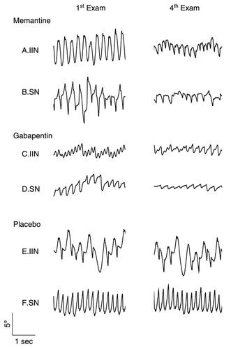 Figure 3. Change in horizontal eye movement before and after treatment for memantine, gabapentin and placebo patients in infantile idiopathic nystagmus (IIN) and secondary nystagmus (SN). Decrease in amplitude of nystagmus for memantine and gabapentin and no change in nystagmus for placebo. Reproduced with permission from McLean et al. [Citation73]