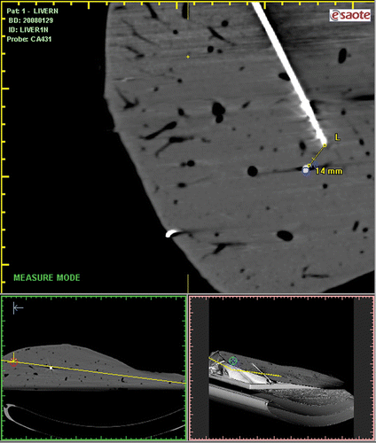 Figure 4. The needle-target distance on post-procedural CT with needles in situ was measured in order to assess the accuracy of needle positioning.