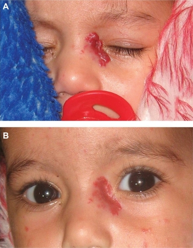 Figure 2 Clinical photographs of a representative case showing a 5-month-old patient with periocular hemangioma. (A) Initial photographs before injection and (B) 4 months after propranolol injection showing good response with marked reduction in size of the lesion.