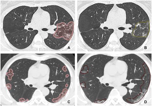 Figure 3 Predict results of the AI system. (A, C): predicted by AI system, (B, D): labeled by radiologist.